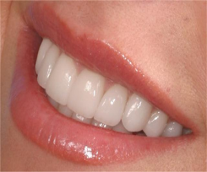 Whitened teeth