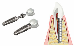 Implant treatment