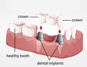 Multiple dental implants