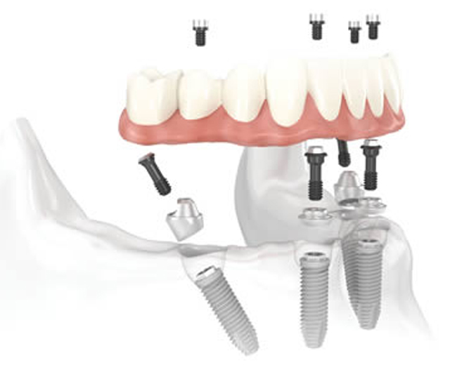 All-on-4® Dental Implants