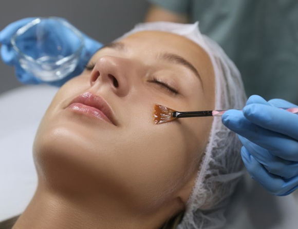 Chemical Peels