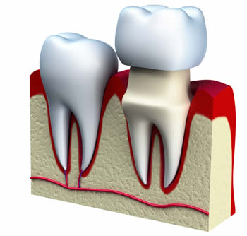 Crowns are used to reinforce teeth.
