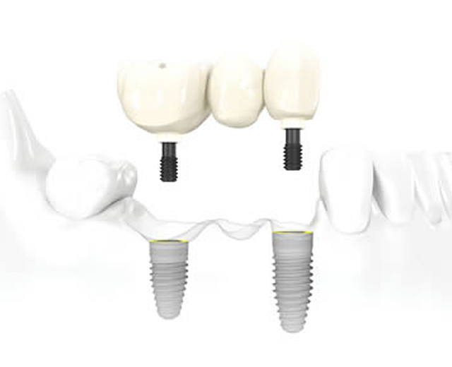 Bridges on Dental Implants