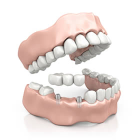 Bridges on Dental Implants