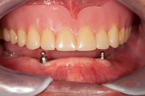 Implant Retained Dentures