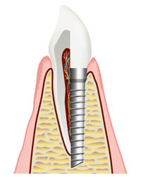 Dental Implants