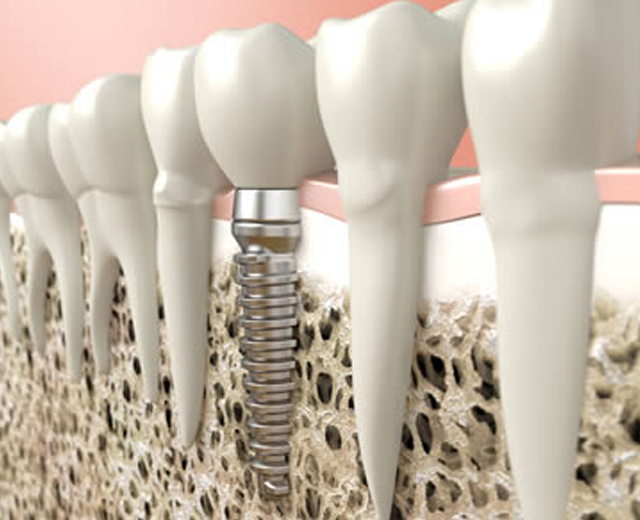 Dental Implants 