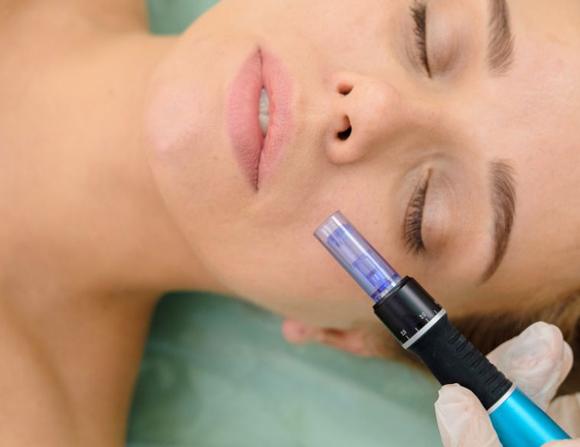 Microneedling