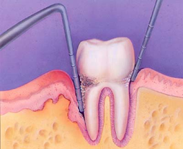 Periodontal disease and treatment