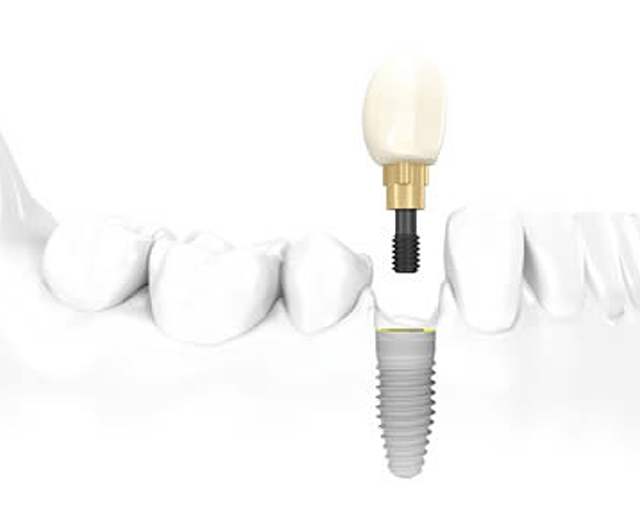 Single Tooth Dental Implants